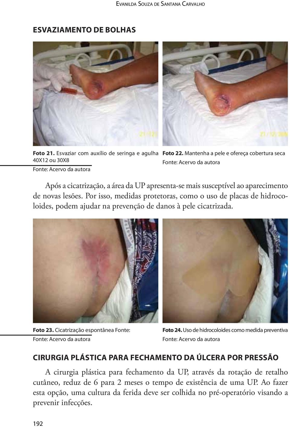 Por isso, medidas protetoras, como o uso de placas de hidrocoloides, podem ajudar na prevenção de danos à pele cicatrizada. Foto 23. Cicatrização espontânea Fonte: Foto 24.