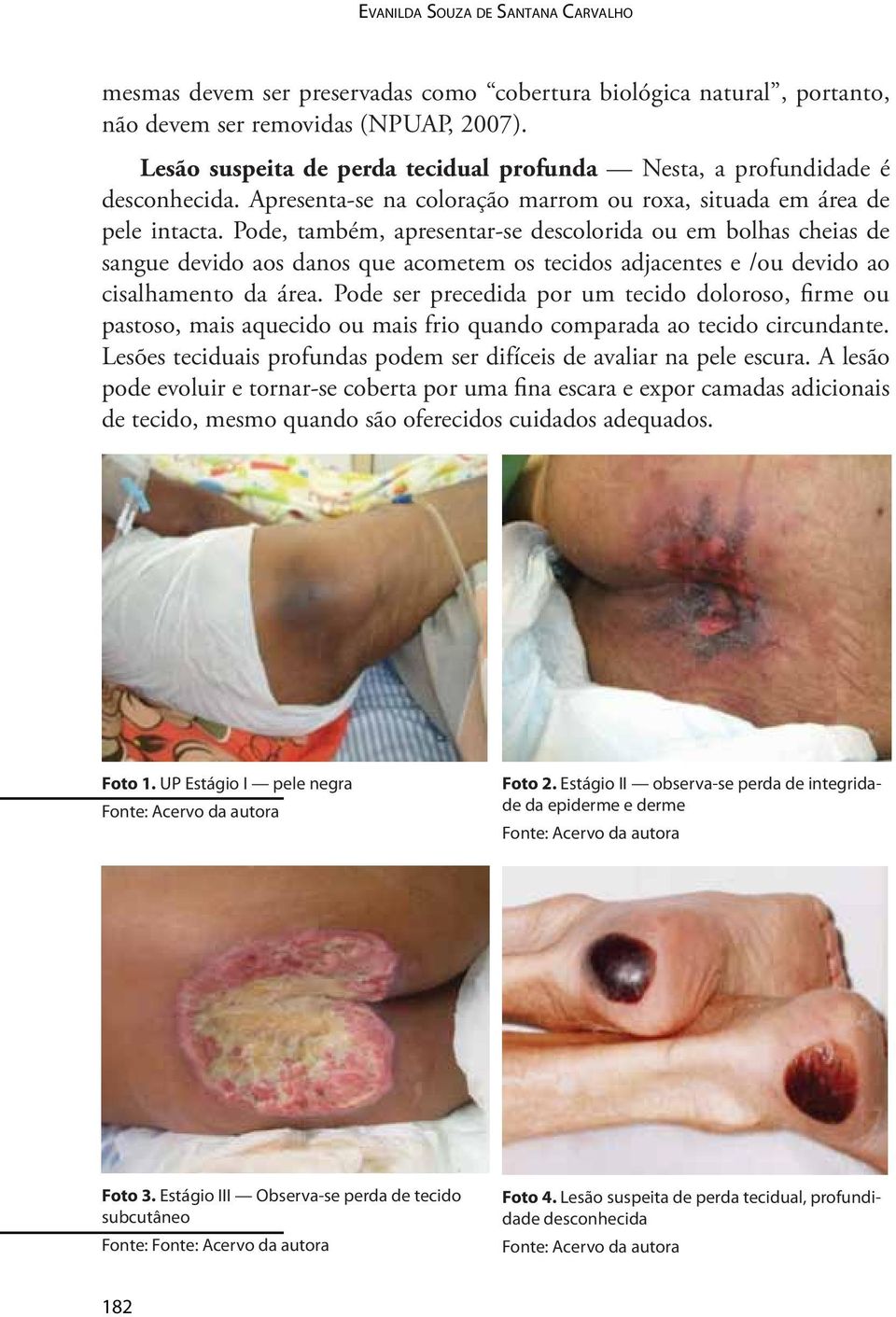 Pode, também, apresentar-se descolorida ou em bolhas cheias de sangue devido aos danos que acometem os tecidos adjacentes e /ou devido ao cisalhamento da área.