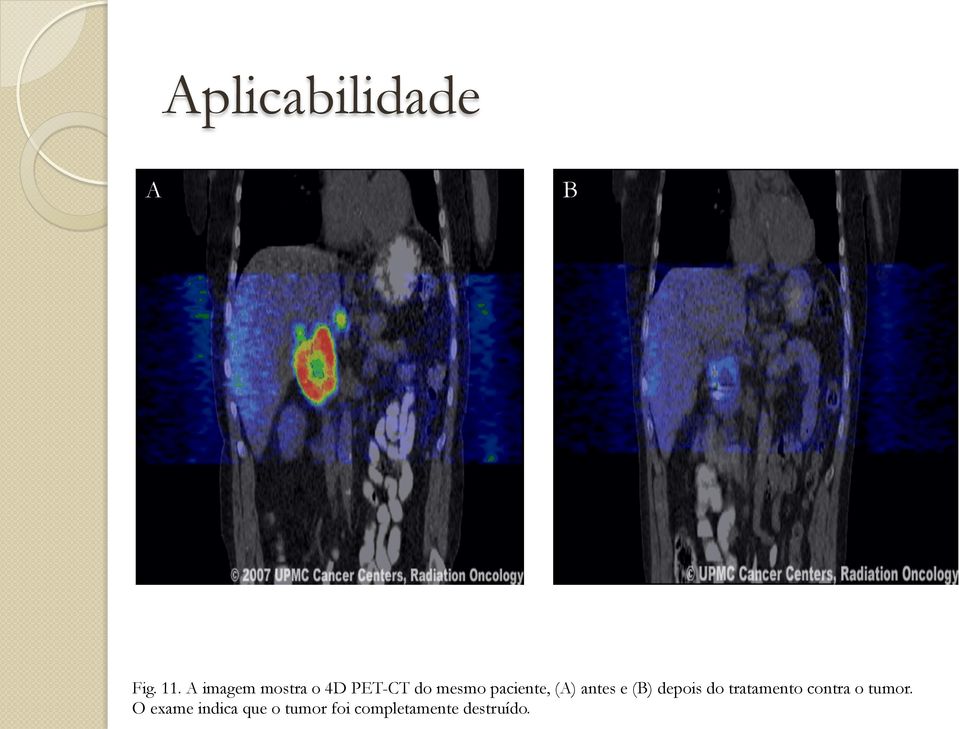 antes e (B) depois do tratamento contra o tumor.