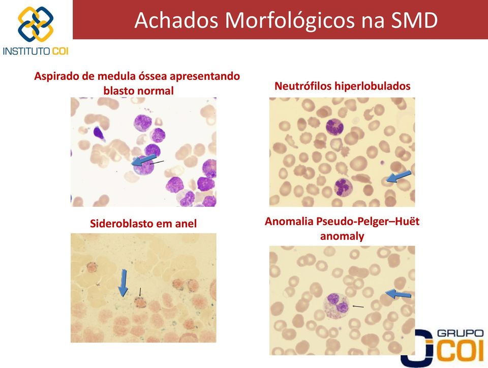 Anomalia Pseudo-Pelger Huët anomaly http://www.healthsystem.