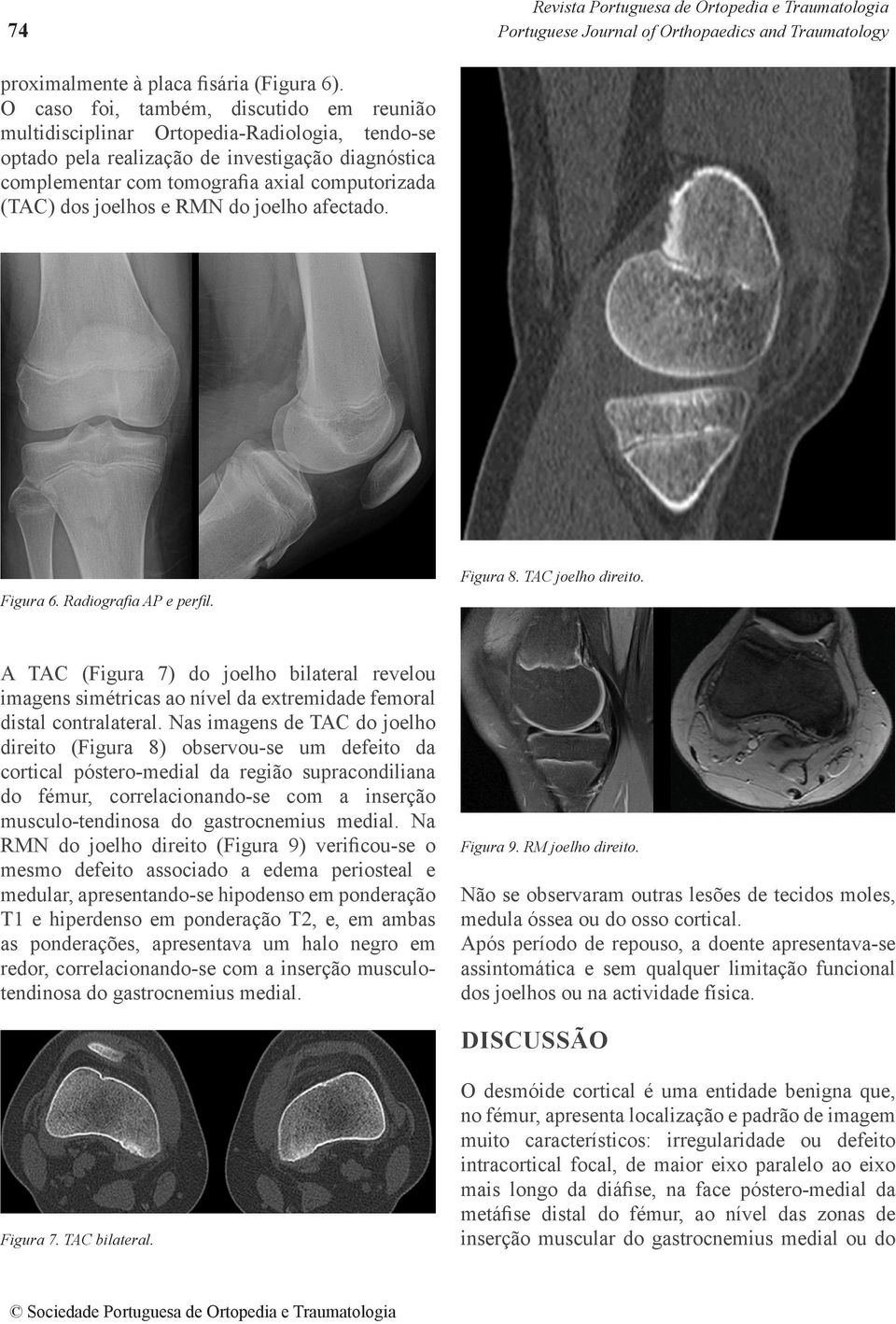 joelhos e RMN do joelho afectado. Figura 8. TAC joelho direito. Figura 6. Radiografia AP e perfil.