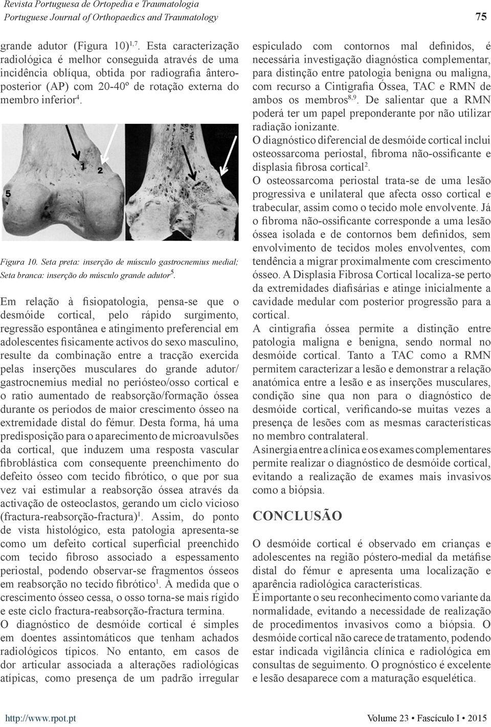 Seta preta: inserção de músculo gastrocnemius medial; Seta branca: inserção do músculo grande adutor 5.