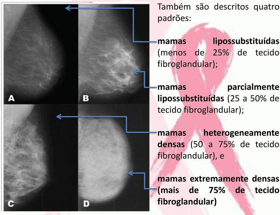 tecido fibroglandular); mamas heterogeneamente densas (50 a 75% de tecido