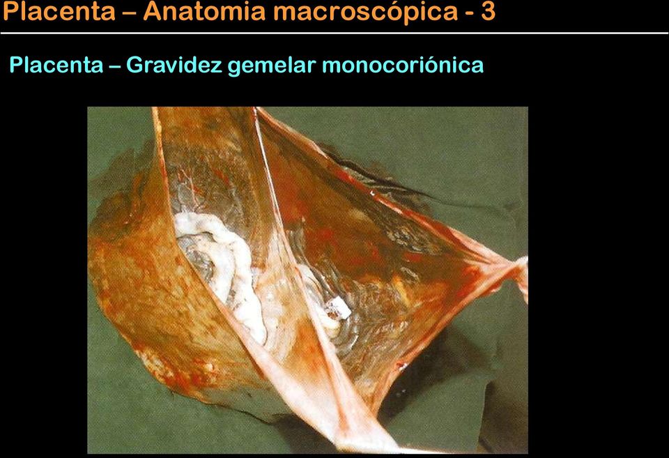 Placenta Gravidez