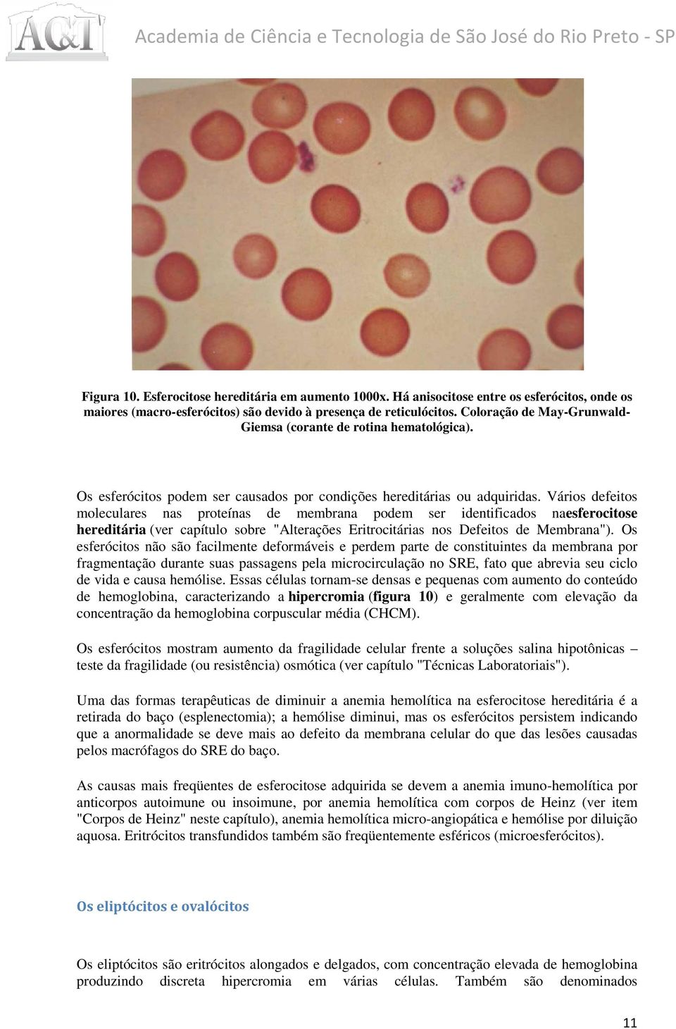 Vários defeitos moleculares nas proteínas de membrana podem ser identificados dos naesferocitose hereditária (ver capítulo sobre "Alterações Eritrocitárias nos Defeitos de Membrana").