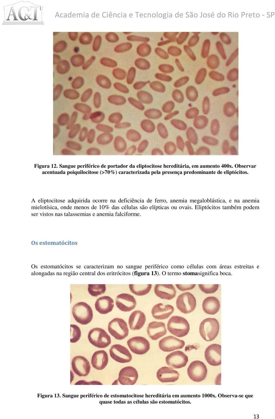 Eliptócitos também podem ser vistos nas talassemias e anemia falciforme.