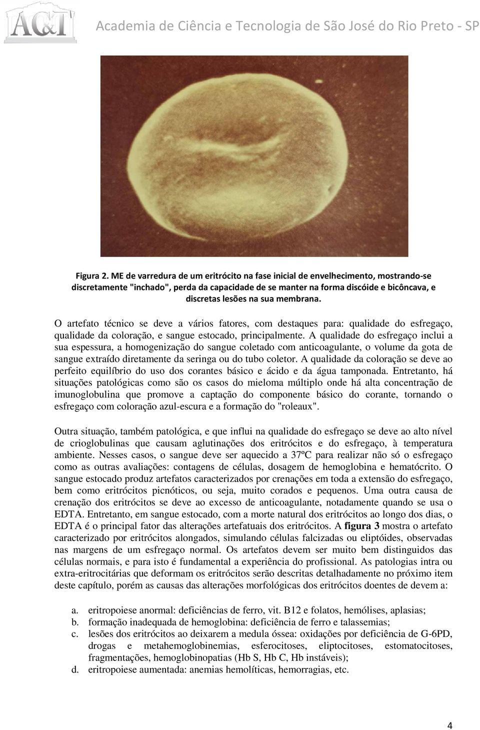 membrana. O artefato técnico se deve a vários fatores, com destaques para: qualidade do esfregaço, qualidade da coloração, e sangue estocado, principalmente.