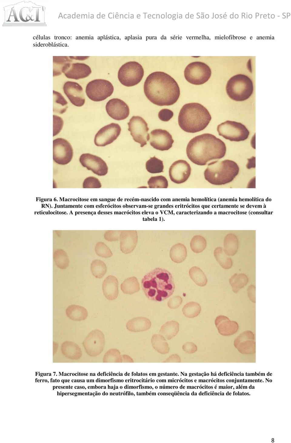 A presença desses macrócitos eleva o VCM, caracterizando a macrocitose (consultar tabela 1). Figura 7. Macrocitose na deficiência de folatos em gestante. te.