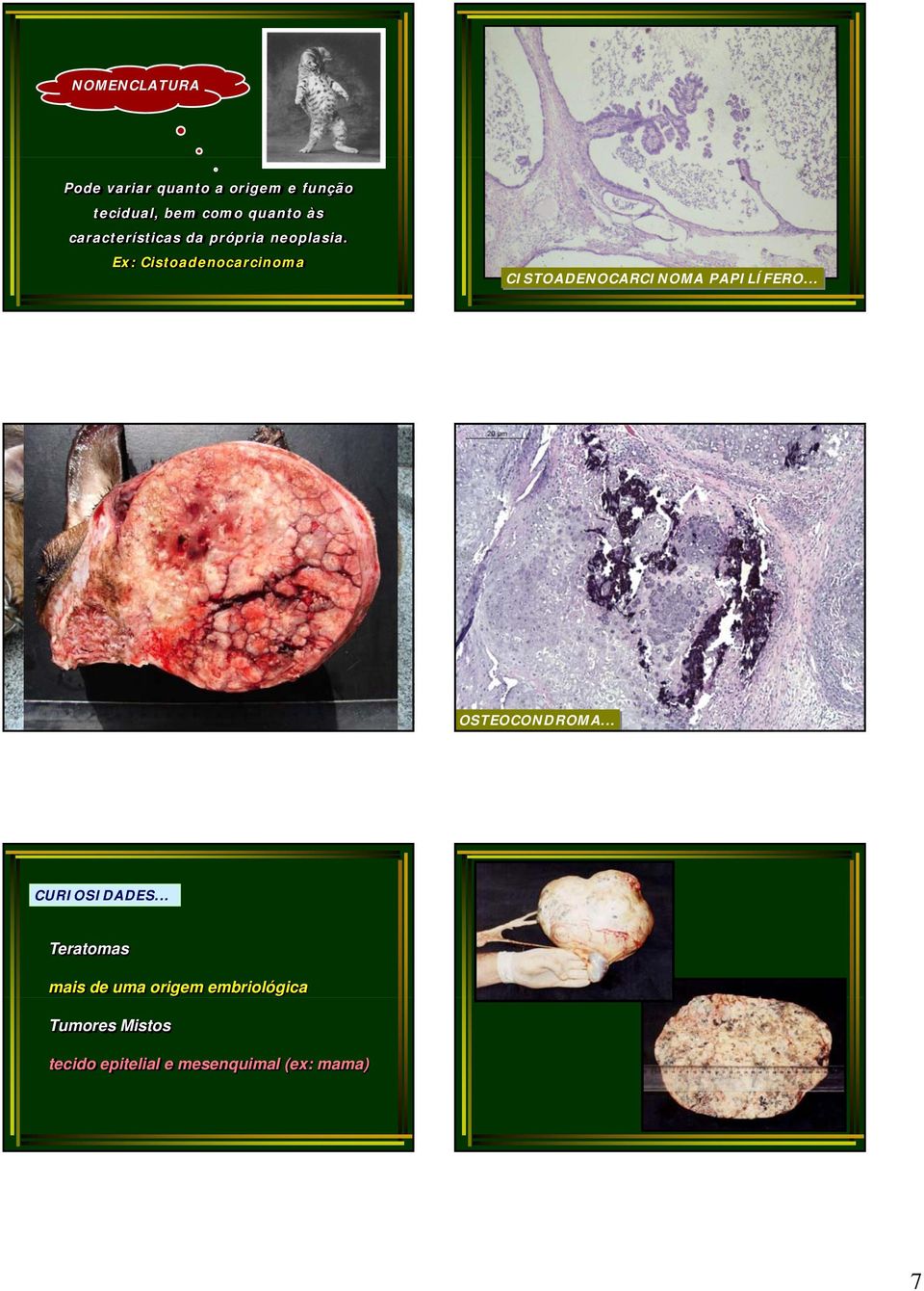 Ex: Cistoadenocarcinoma CISTOADENOCARCINOMA PAPILÍFERO... OSTEOCONDROMA.