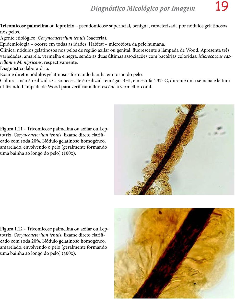 Clínica: nódulos gelatinosos nos pelos de região axilar ou genital, fluorescente à lâmpada de Wood.