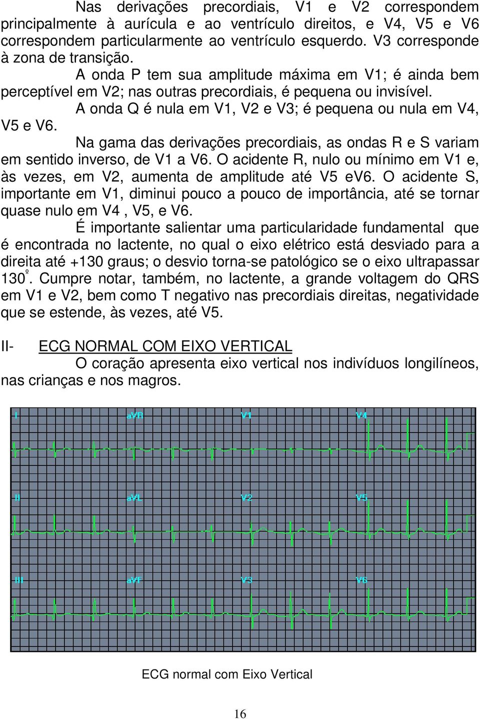 A onda Q é nula em V1, V2 e V3; é pequena ou nula em V4, V5 e V6. Na gama das derivações precordiais, as ondas R e S variam em sentido inverso, de V1 a V6.