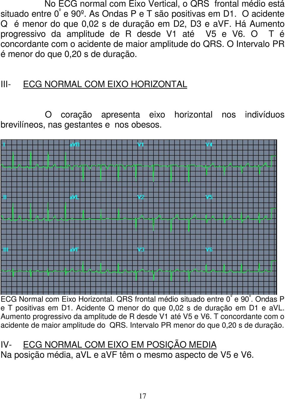 III- ECG NORMAL COM EIXO HORIZONTAL O coração apresenta eixo horizontal nos indivíduos brevilíneos, nas gestantes e nos obesos. ECG Normal com Eixo Horizontal.