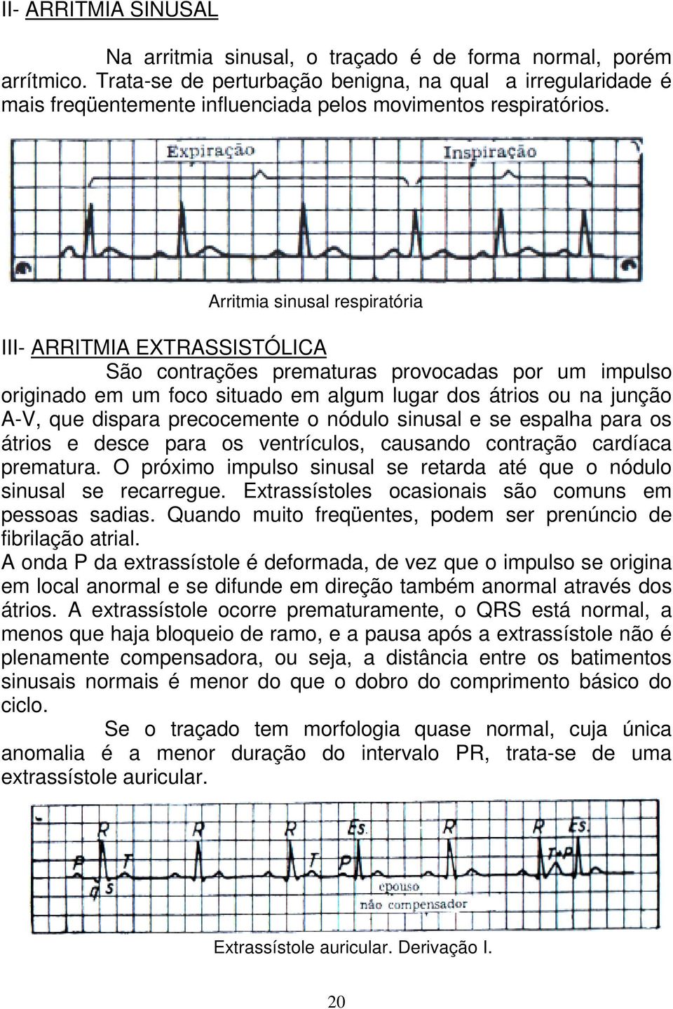 Arritmia sinusal respiratória III- ARRITMIA EXTRASSISTÓLICA São contrações prematuras provocadas por um impulso originado em um foco situado em algum lugar dos átrios ou na junção A-V, que dispara