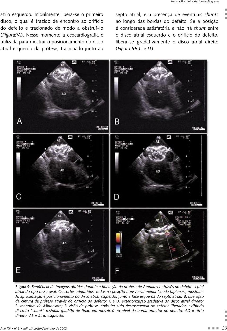 do defeito. Se a posição é considerada satisfatória e não há shunt entre o disco atrial esquerdo e o orifício do defeito, libera-se gradativamente o disco atrial direito (Figura 9B,C e D). Figura 9.