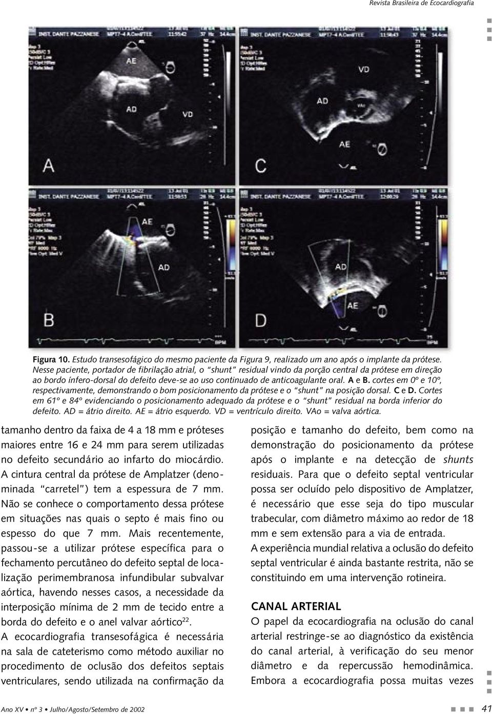 cortes em 0º e 10º, respectivamente, demonstrando o bom posicionamento da prótese e o shunt na posição dorsal. C e D.