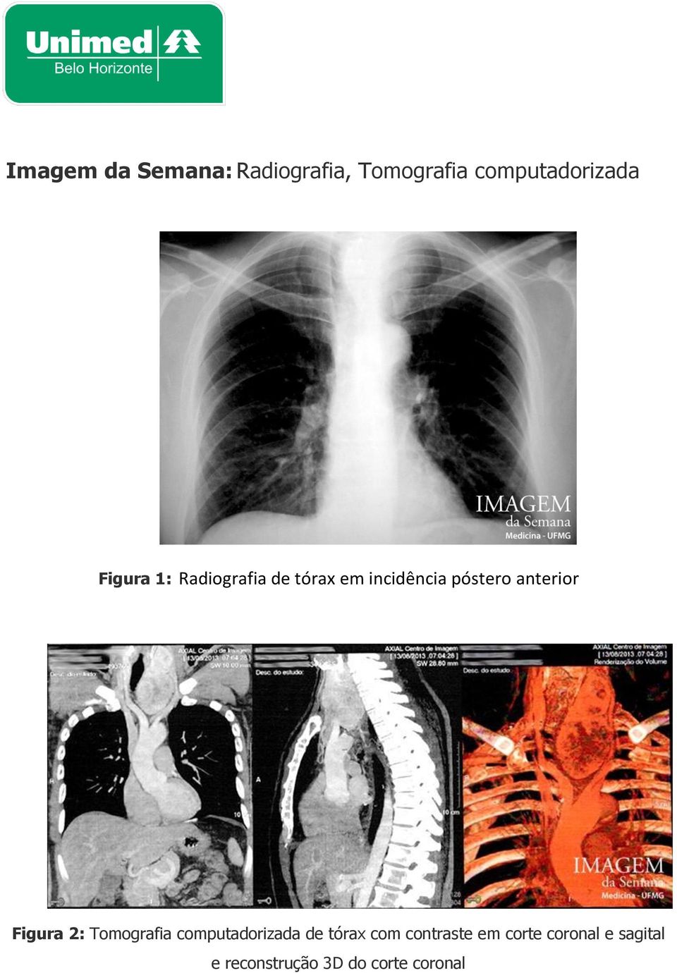 anterior Figura 2: Tomografia computadorizada de tórax com