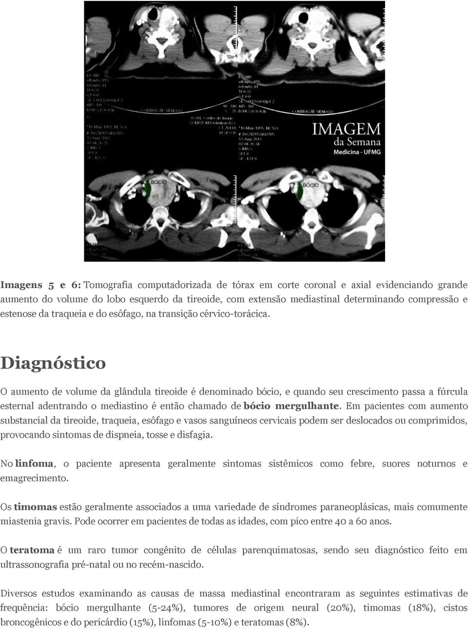 Diagnóstico O aumento de volume da glândula tireoide é denominado bócio, e quando seu crescimento passa a fúrcula esternal adentrando o mediastino é então chamado de bócio mergulhante.