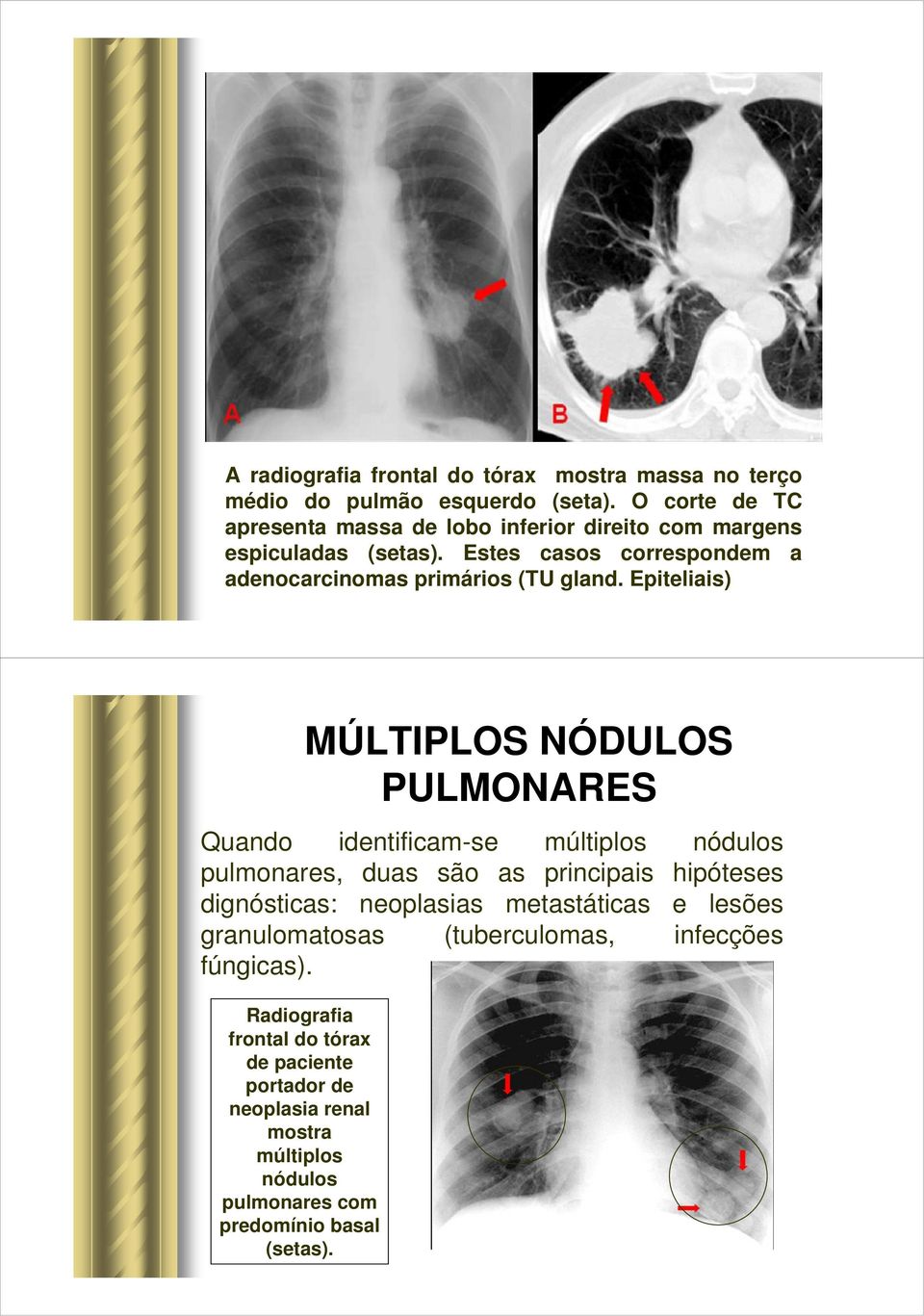 Estes casos correspondem a adenocarcinomas primários (TU gland.