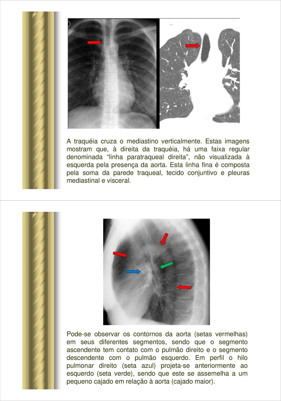 Esta linha fina é composta pela soma da parede traqueal, tecido conjuntivo e pleuras mediastinal e visceral.