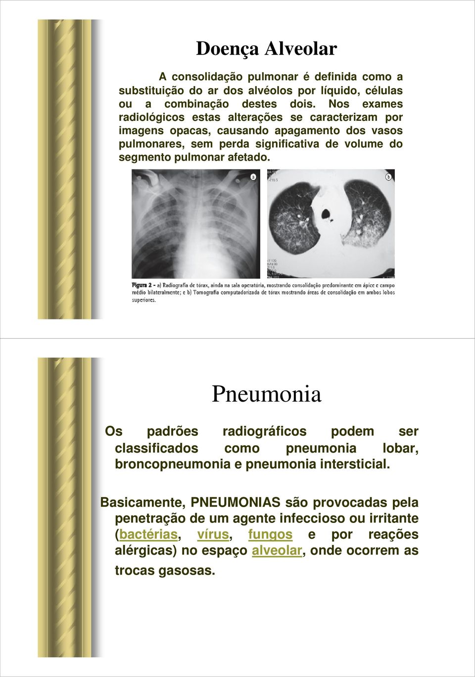 segmento pulmonar afetado. Pneumonia Os padrões radiográficos podem ser classificados como pneumonia lobar, broncopneumonia e pneumonia intersticial.