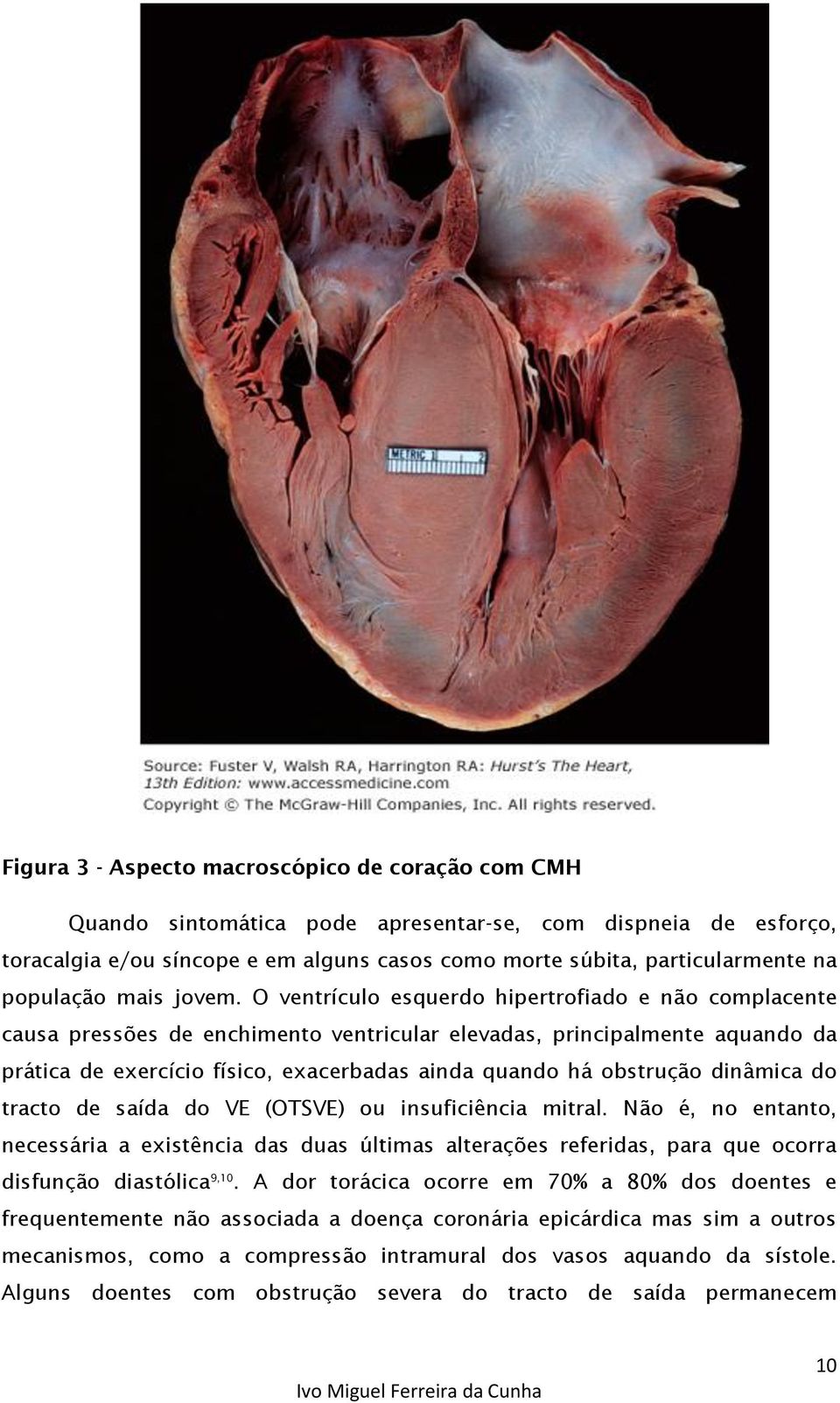 O ventrículo esquerdo hipertrofiado e não complacente causa pressões de enchimento ventricular elevadas, principalmente aquando da prática de exercício físico, exacerbadas ainda quando há obstrução