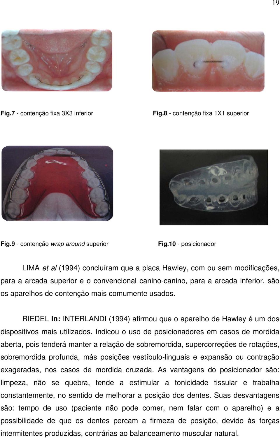 contenção mais comumente usados. RIEDEL In: INTERLANDI (1994) afirmou que o aparelho de Hawley é um dos dispositivos mais utilizados.