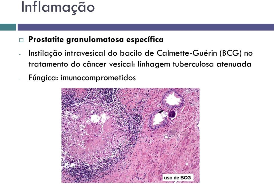 Calmette-Guérin (BCG) no tratamento do câncer