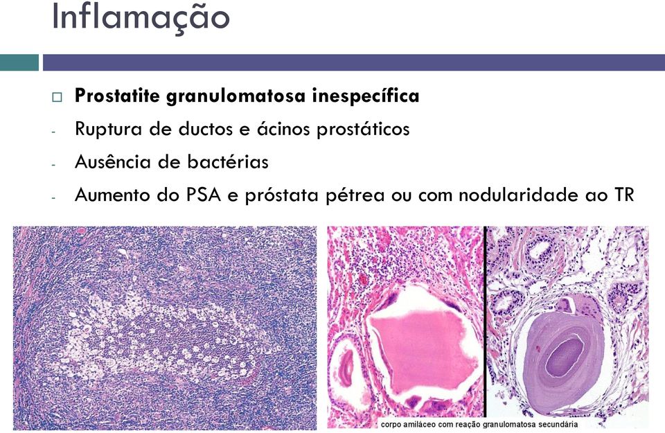 prostáticos - Ausência de bactérias -