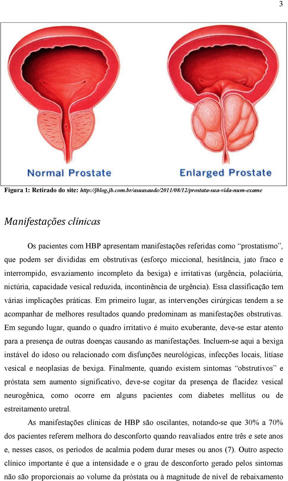 miccional, hesitância, jato fraco e interrompido, esvaziamento incompleto da bexiga) e irritativas (urgência, polaciúria, nictúria, capacidade vesical reduzida, incontinência de urgência).