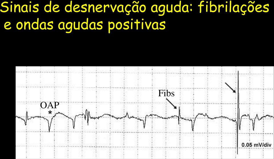 fibrilações e