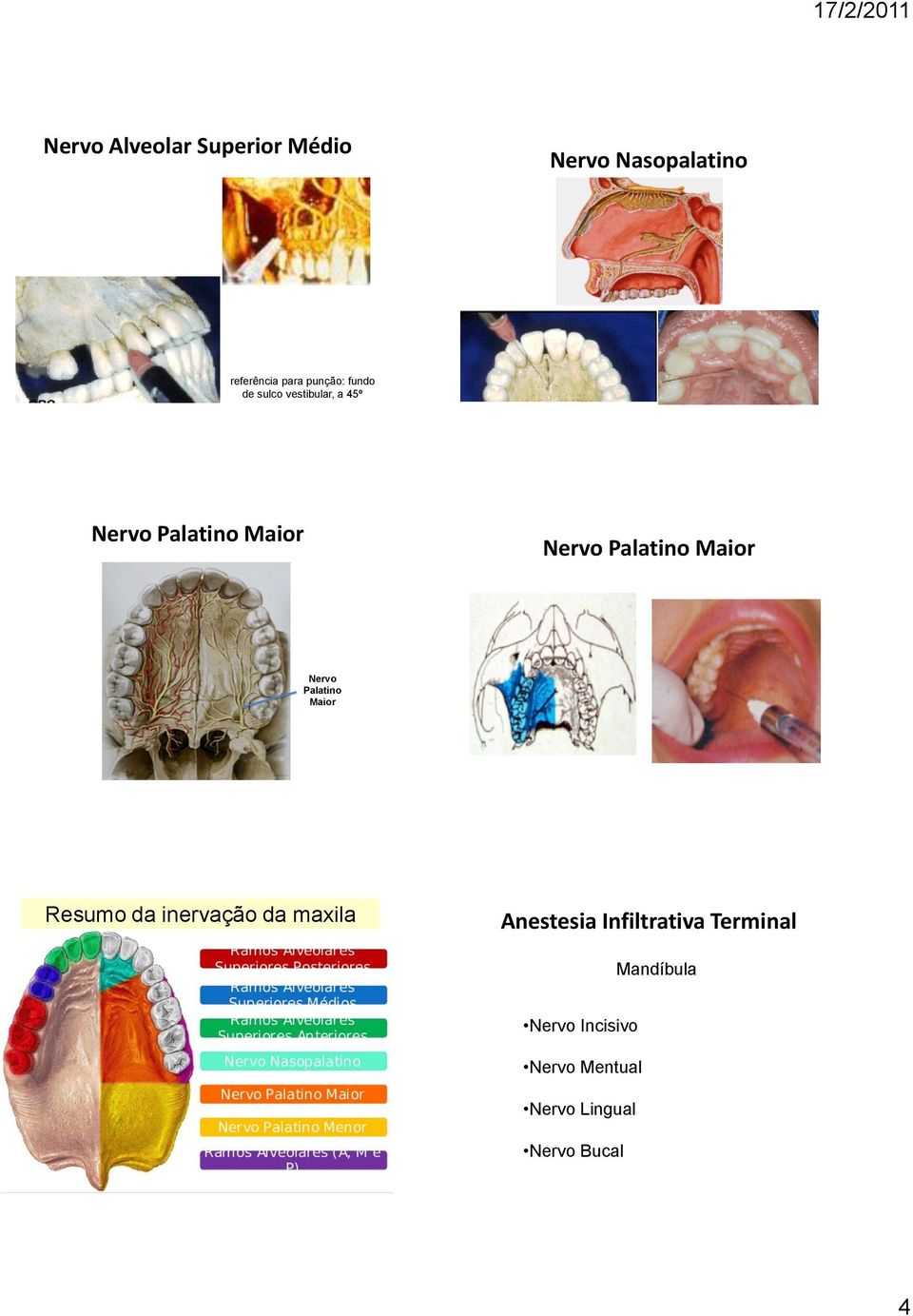 Nervo Palatino Maior Resumo da inervação da maxila Anestesia Infiltrativa