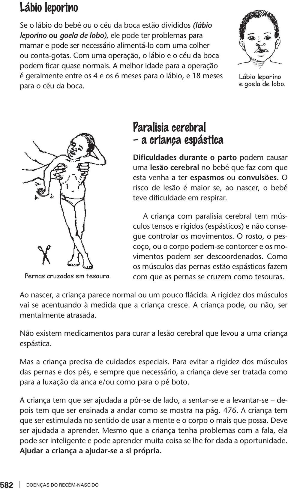 Lábio leporino e goela de lobo. Paralisia cerebral a criança espástica Dificuldades durante o parto podem causar uma lesão cerebral no bebé que faz com que esta enha a ter espasmos ou conulsões.