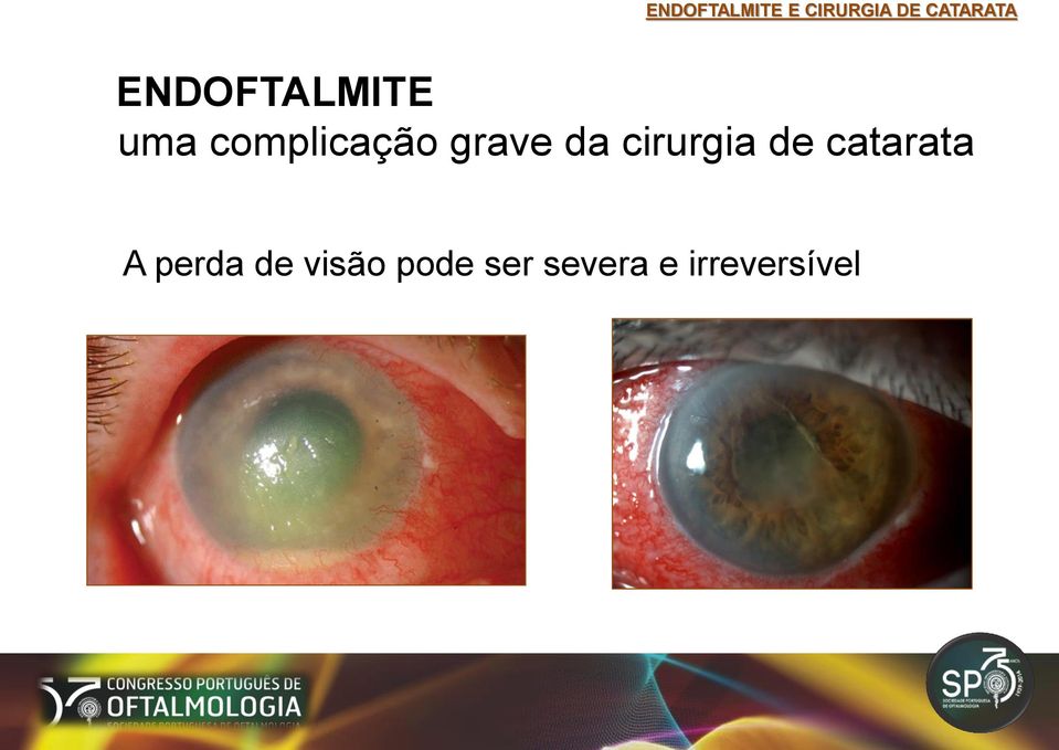 cirurgia de catarata A