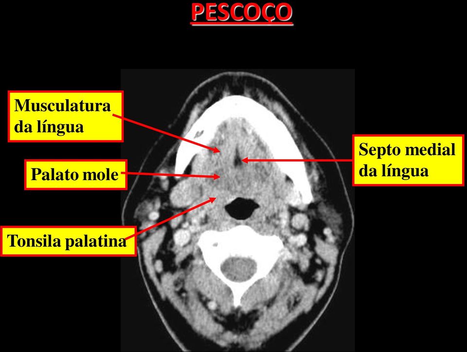 mole Septo medial da