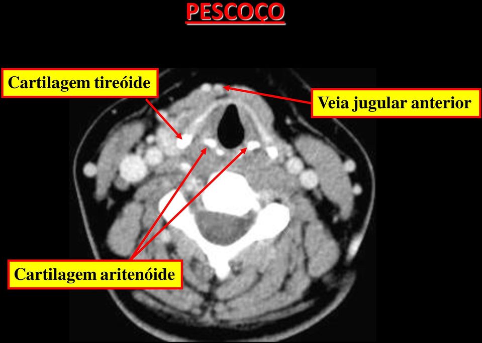 tireóide Veia