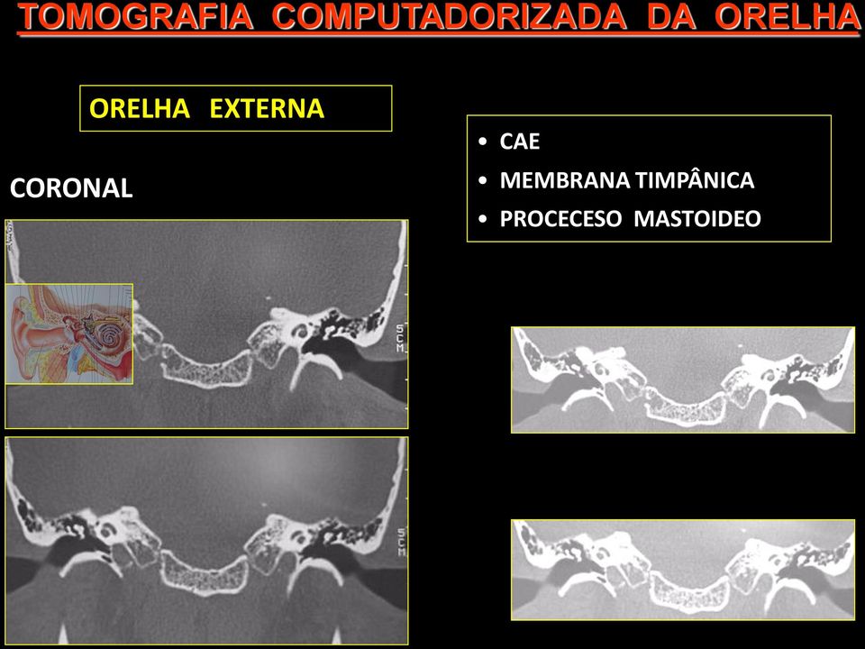 CORONAL ORELHA EXTERNA