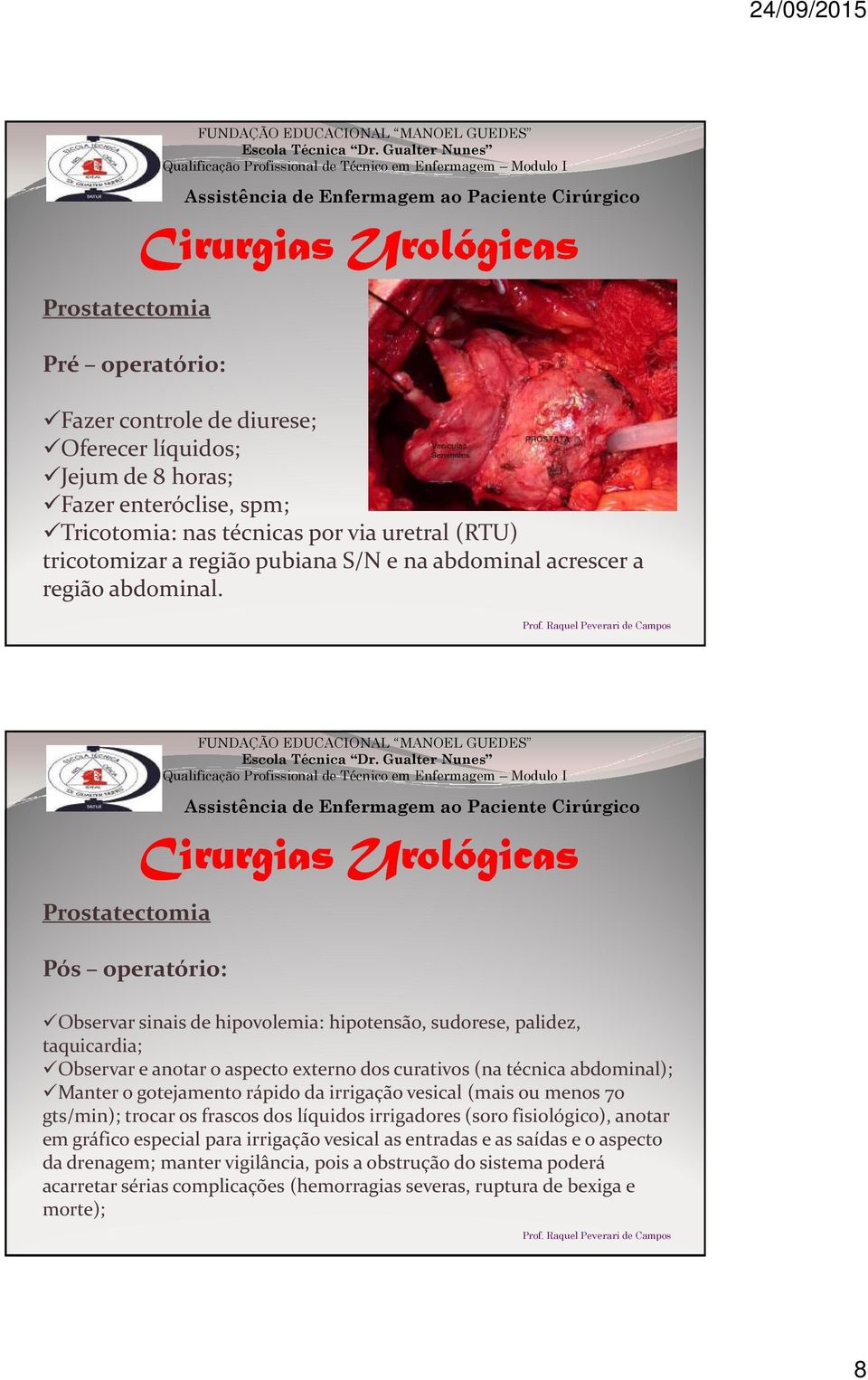 Prostatectomia Pós operatório: Cirurgias Urológicas Observar sinais de hipovolemia: hipotensão, sudorese, palidez, taquicardia; Observar e anotar o aspecto externo dos curativos (na técnica