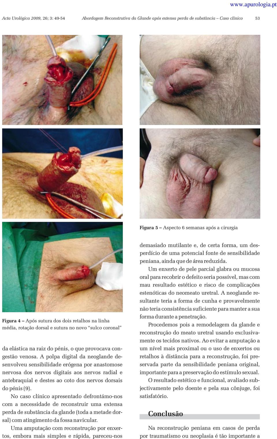 A polpa digital da neoglande desenvolveu sensibilidade erógena por anastomose nervosa dos nervos digitais aos nervos radial e antebraquial e destes ao coto dos nervos dorsais do pénis (9).