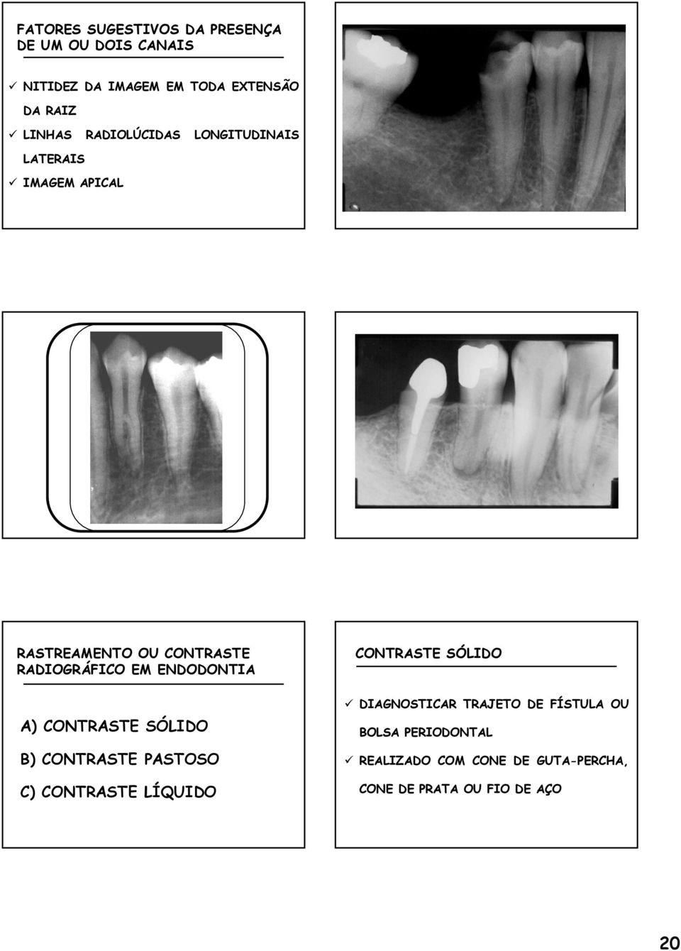 ENDODONTIA A) CONTRASTE SÓLIDO B) CONTRASTE PASTOSO C) CONTRASTE LÍQUIDO CONTRASTE SÓLIDO