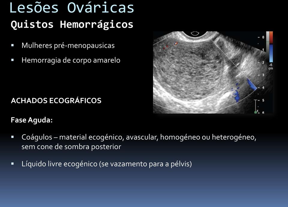 Coágulos material ecogénico, avascular, homogéneo ou heterogéneo,