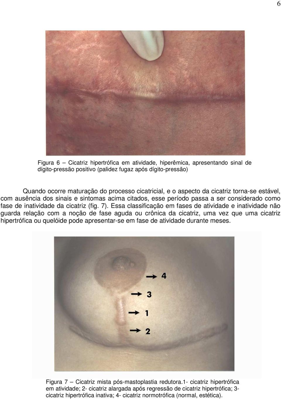 Essa classificação em fases de atividade e inatividade não guarda relação com a noção de fase aguda ou crônica da cicatriz, uma vez que uma cicatriz hipertrófica ou quelóide pode apresentar-se em