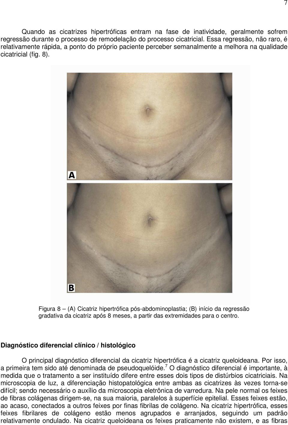 Figura 8 (A) Cicatriz hipertrófica pós-abdominoplastia; (B) início da regressão gradativa da cicatriz após 8 meses, a partir das extremidades para o centro.