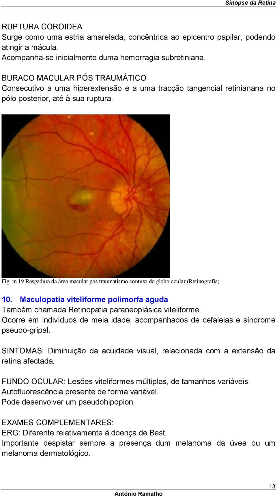 19 Rasgadura da área macular pós traumatismo contuso do globo ocular (Retinografia) 10. Maculopatia viteliforme polimorfa aguda Também chamada Retinopatia paraneoplásica viteliforme.