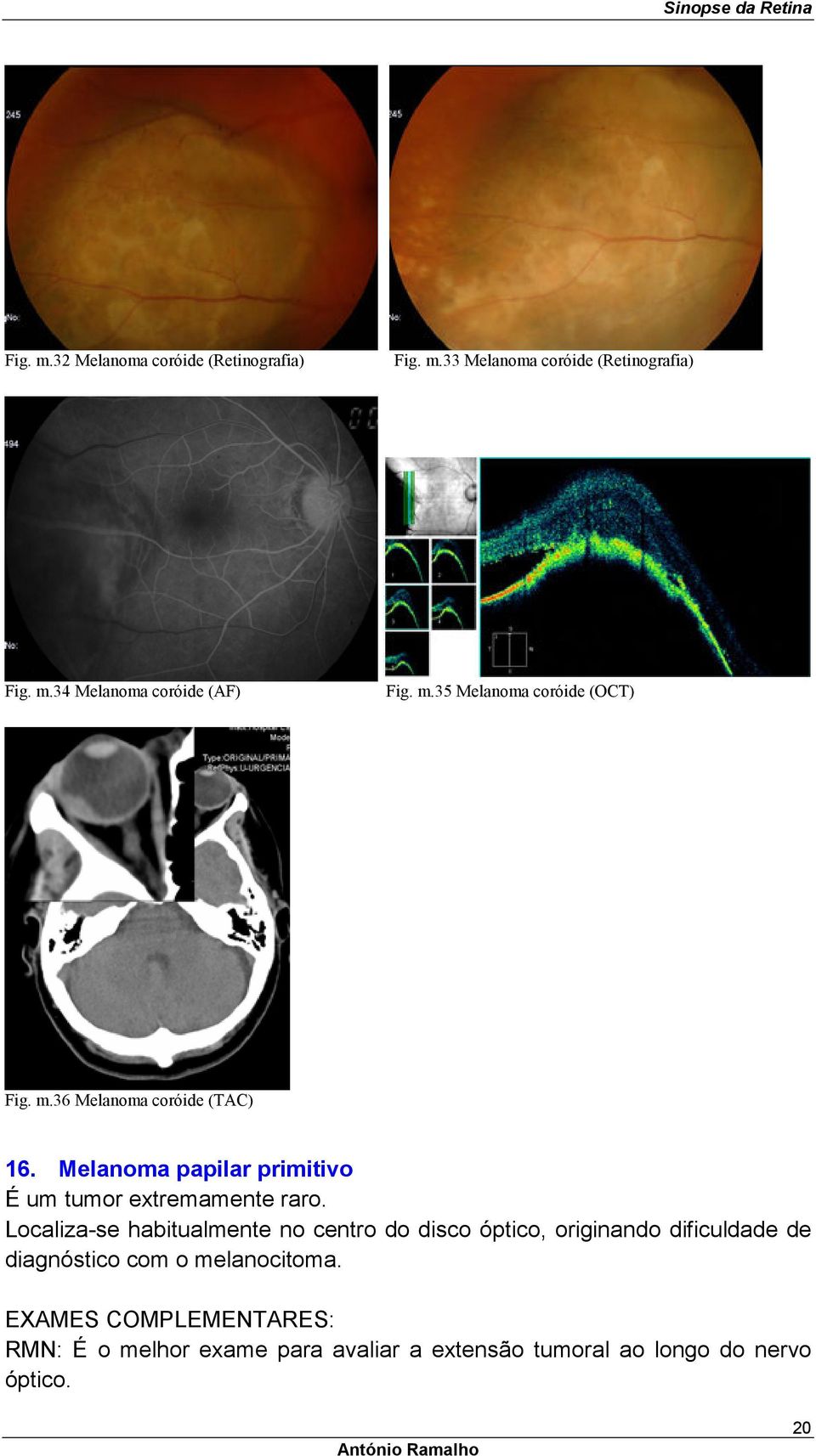 Melanoma papilar primitivo É um tumor extremamente raro.