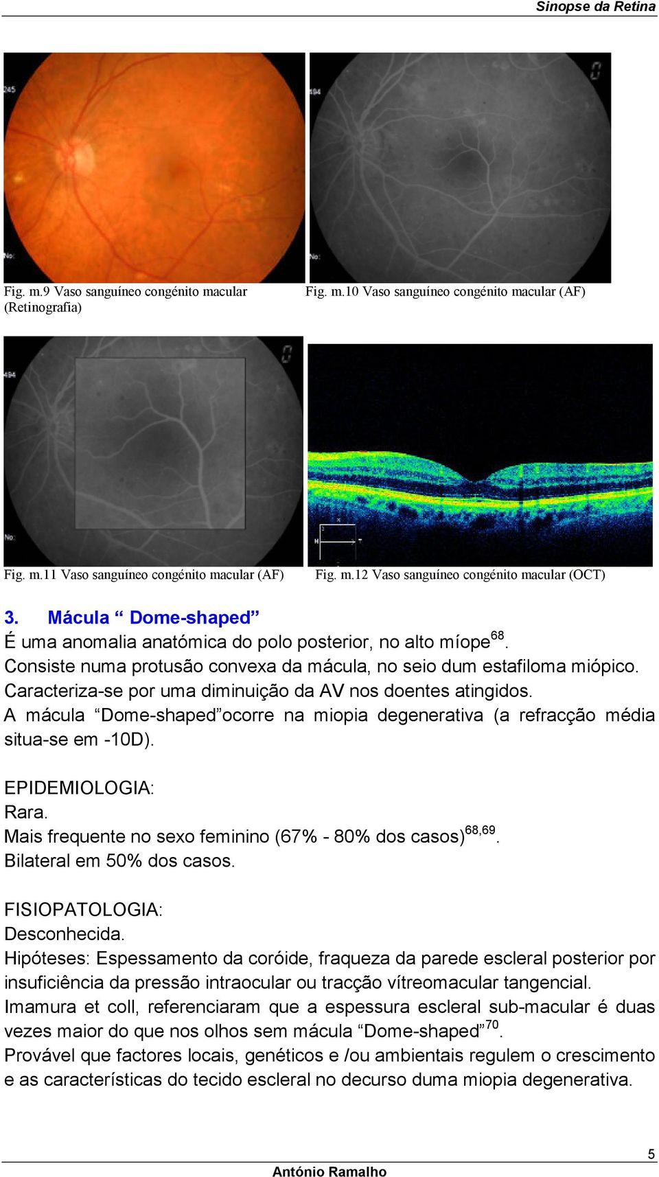Caracteriza-se por uma diminuição da AV nos doentes atingidos. A mácula Dome-shaped ocorre na miopia degenerativa (a refracção média situa-se em -10D). EPIDEMIOLOGIA: Rara.