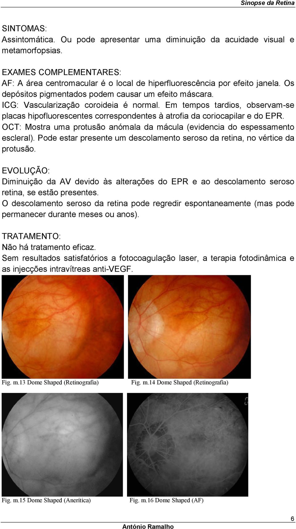 Em tempos tardios, observam-se placas hipofluorescentes correspondentes à atrofia da coriocapilar e do EPR. OCT: Mostra uma protusão anómala da mácula (evidencia do espessamento escleral).