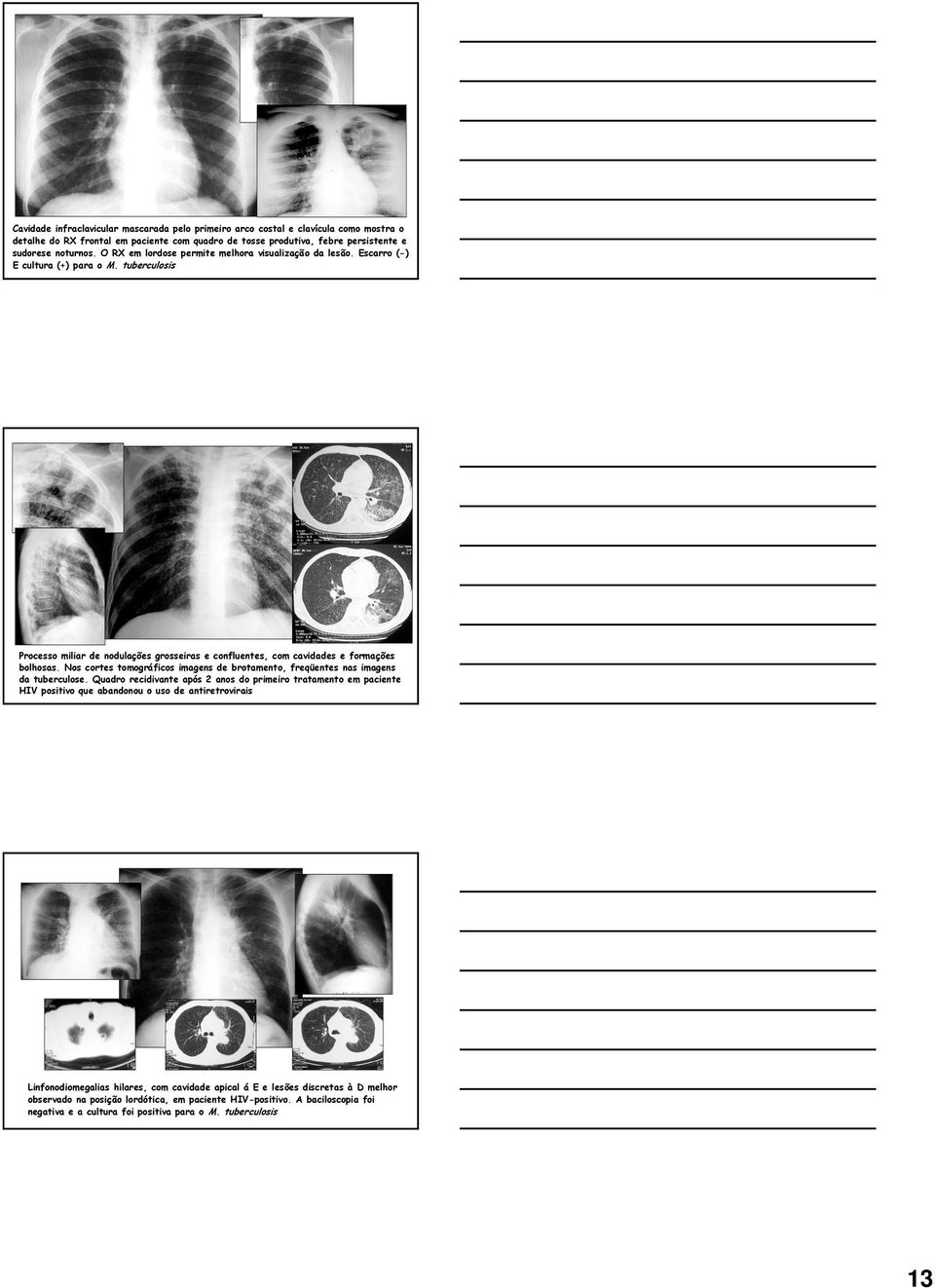 Nos cortes tomográficos imagens de brotamento, freqüentes nas imagens da tuberculose.