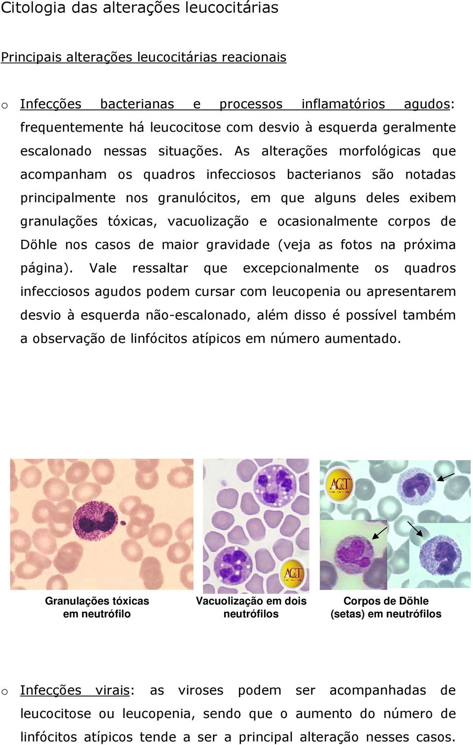 As lterções morfológics que compnhm os qudros infecciosos bcterinos são notds principlmente nos grnulócitos, em que lguns deles exibem grnulções tóxics, vcuolizção e ocsionlmente corpos de Döhle nos