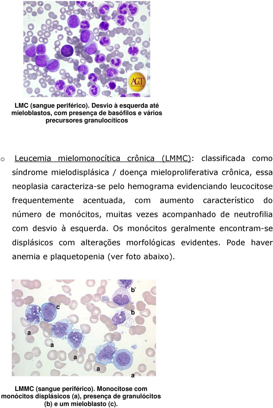 mielodisplásic / doenç mieloprolifertiv crônic, ess neoplsi crcteriz-se pelo hemogrm evidencindo leucocitose frequentemente centud, com umento crcterístico do número