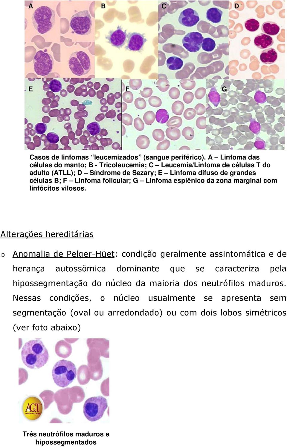 foliculr; G Linfom esplênico d zon mrginl com linfócitos vilosos.